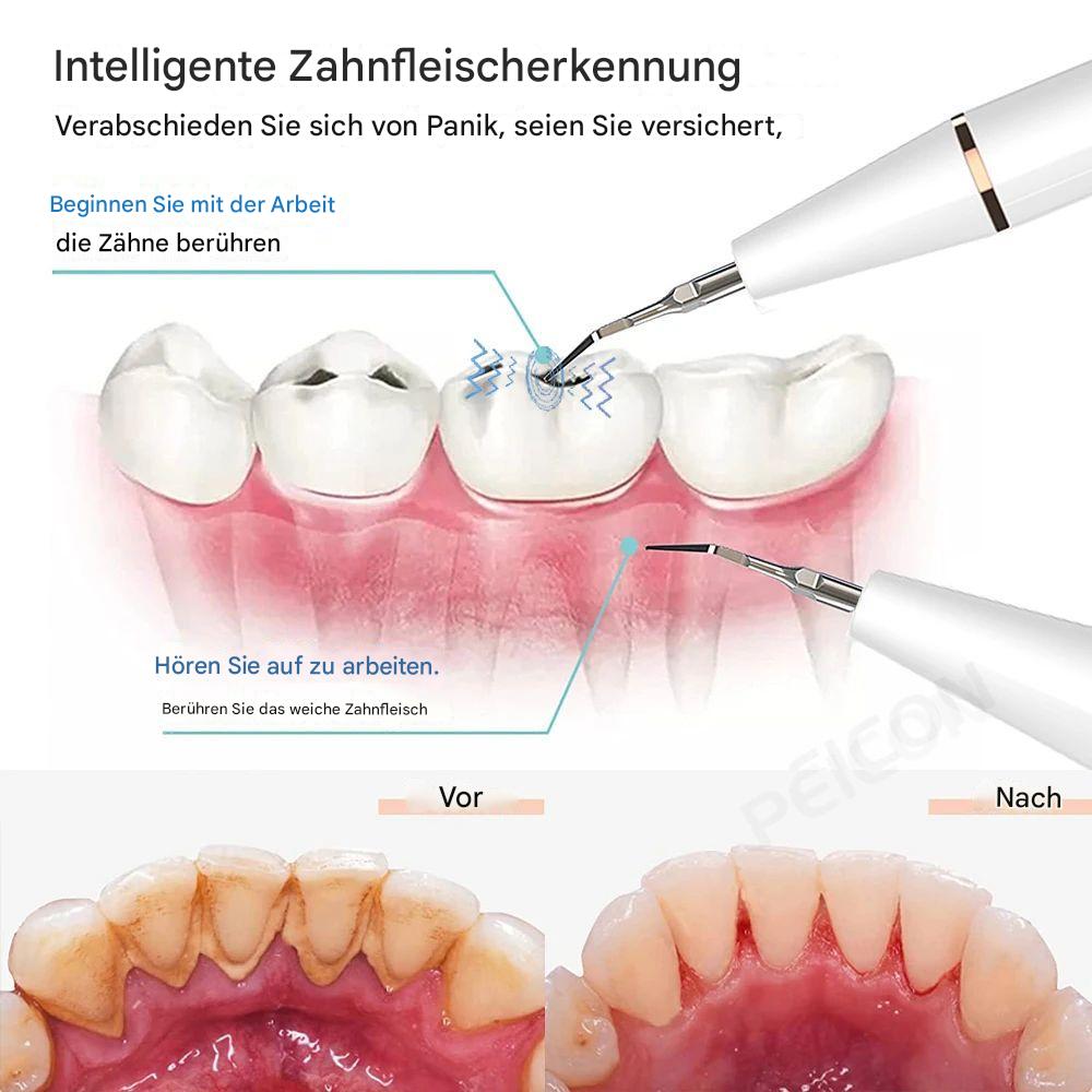 Ultrasonic Dental Tartar Remover | Plaque & Calculus Cleaner